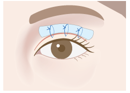 ボルスター固定