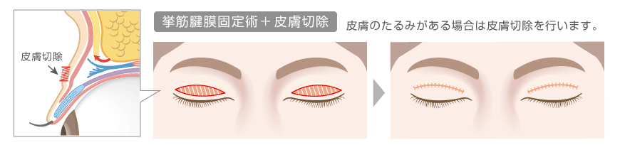 挙筋腱膜再固定術＋皮膚切除