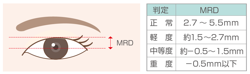 MRD