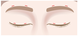 前頭筋つり上げ