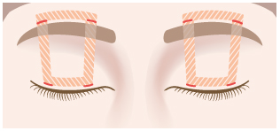 前頭筋つり上げ