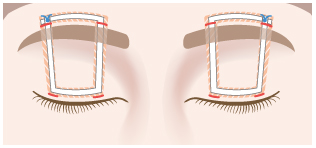 前頭筋つり上げ