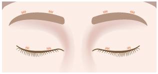 前頭筋つり上げ