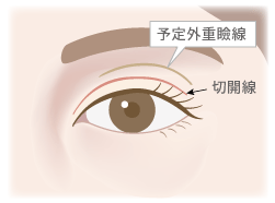 予定外重瞼線