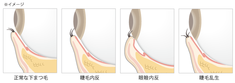 眼瞼内反症の種類