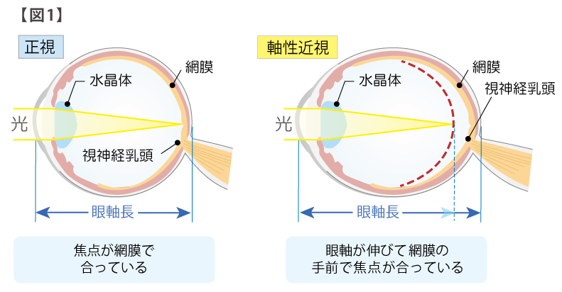 正視と近視の図