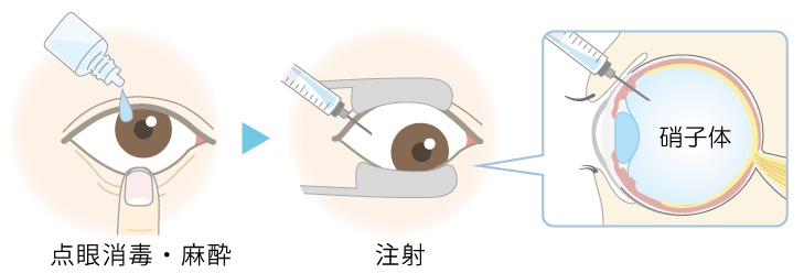 抗VEGF治療の方法